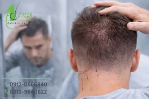 ریزش موهای کاشته شده طبیعیه ؟