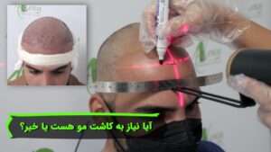 راهکار های قبل از کاشت مو
