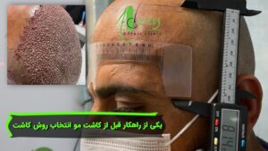 یکی از راهکار قبل از کاشت مو انتخاب روش کاشت