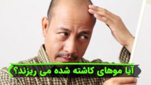 آیا موهای کاشته شده می ریزند؟