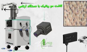 کاشت مو رباتیک با دستگاه Artas