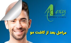 مراقبت های بعد از کاشت مو