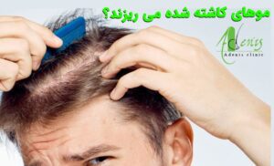 موهای کاشته شده می ریزند؟