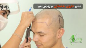 داروی بدنسازی و ریزش مو