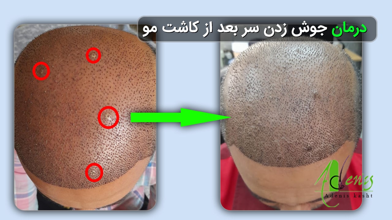 درمان جوش زدن سر بعد از کاشت مو 