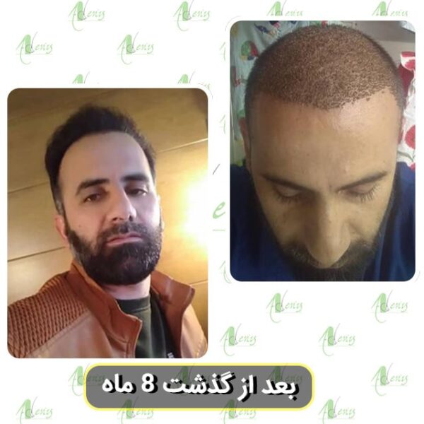 کاشت مو 8