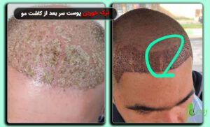 ترک خوردن پوست سر بعد از کاشت مو