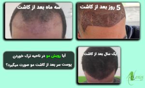 رویش مو در کاشت مو