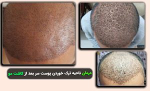 درمان ناحیه ترک خوردن پوست سر بعد از کاشت مو