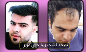 نتیجه کاشت مو