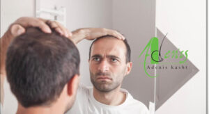 بررسی وضعیت مو در ماه‌های اول بعد از کاشت مو