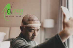 فصل مناسب کاشت مو