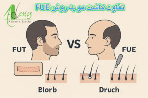تصویر آموزشی مقایسه کاشت مو به روش FUT با روش‌های جدید مانند FUE و SUT