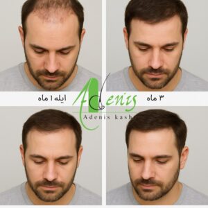  مراحل مختلف رشد مو بعد از کاشت از ماه اول تا دوازدهم
