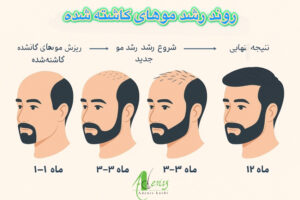  نمای نزدیک از فولیکول‌های مو در مراحل رشد بعد از کاشت