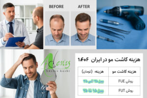 هزینه کاشت مو در روش های مختلف