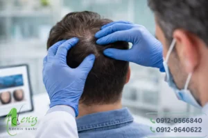 بررسی بانک مو برای رفع باورهای غلط کاشت مو درباره محدودیت تراکم