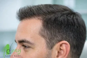 نتیجه طبیعی کاشت مو و بررسی باورهای غلط درباره مصنوعی بودن آن