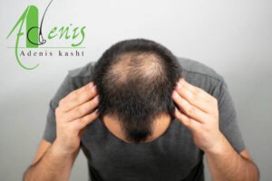 ریزش موهای کاشته شده
