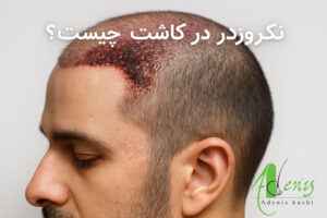 نکروز در کاشت مو چیست
