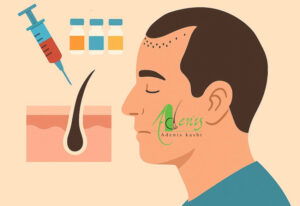 مزوتراپی بعد از کاشت مو