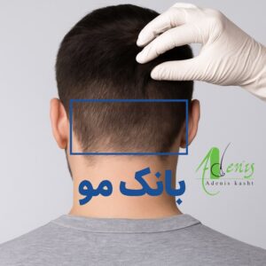 بانک مو در کاشت مو