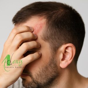 خارش ناحیه کاشت مو