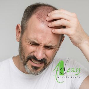 ضربه به محل کاشت مو