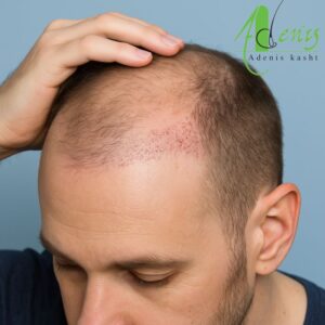 ریزش مو های کاشت شده