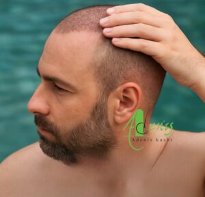 خودارضایی بعد از کاشت مو