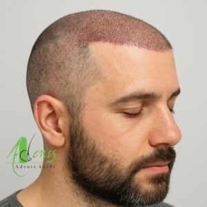 عوارض خودارضایی بر ریزش مو