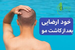 خودارضایی برای کاشت مو