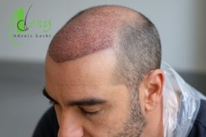 کاشت مو بدون احتیاج به بانک مو