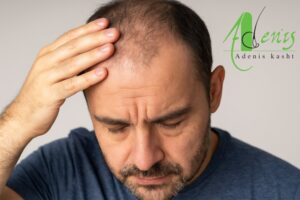 کاشت مو درد دارد ؟