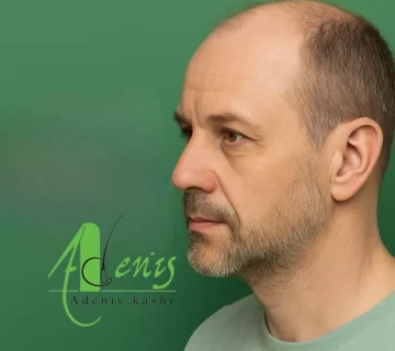 کاشت مو بیماران ام اس