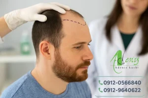 کاشت مو برای بیماران ms