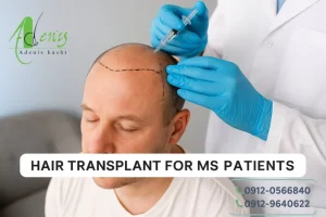 کاشت مو با بیماری ام اس