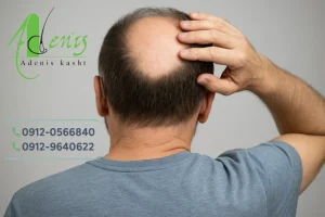 آیا بیماران ام اس میتوانند کاشت مو انجام دهند ؟