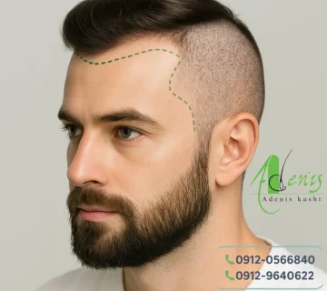 همه چیز در مورد کاشت موی طبیعی