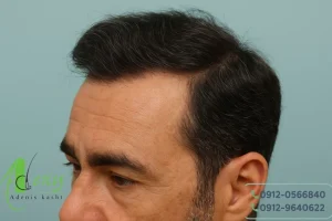 کاشت مو در تهران