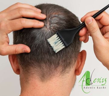 رنگ کردن مو بعد از کاشت مو