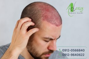 دلیل خارش سر بعد از کاشت مو