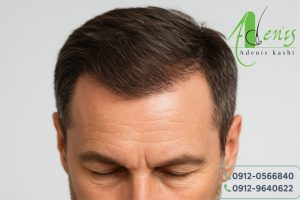 رفع خارش سر بعد از کاشت مو