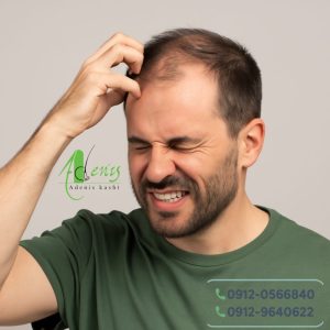 خارش مو بعد از کاشت مو