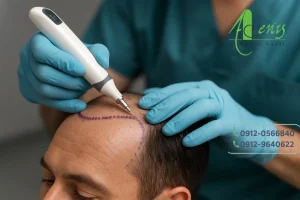 رشد مو بدون نیاز به کاشت مو