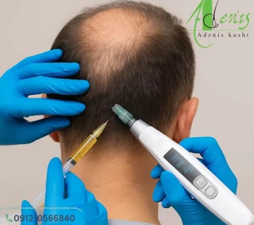 رشد مجدد مو بدون کاشت مو