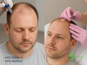 رشد مو بدون کاشت مو