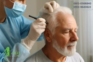 کاشت موی سفید