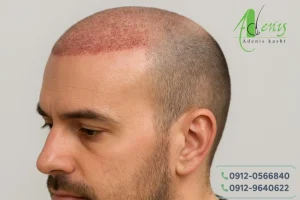 قرمزی محل کاشت مو