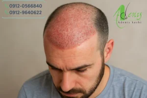 قرمز شدن محل کاشت مو